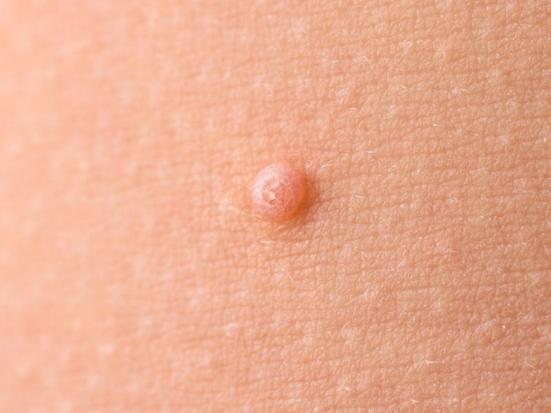 Molluscum Contagiosum